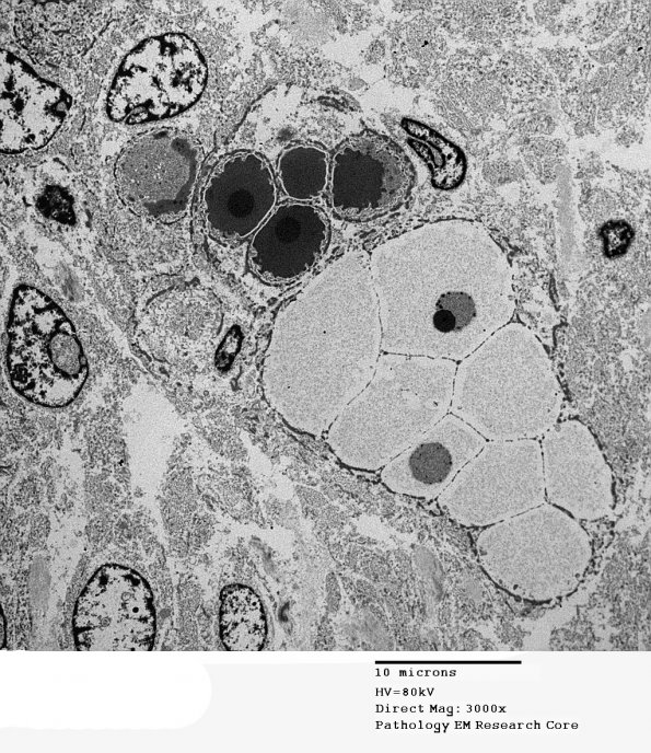 5H6 Meningioma, secretory (Case 5) EM 9 - Copy