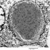 5H7 Meningioma, secretory (Case 5) EM 10 - Copy