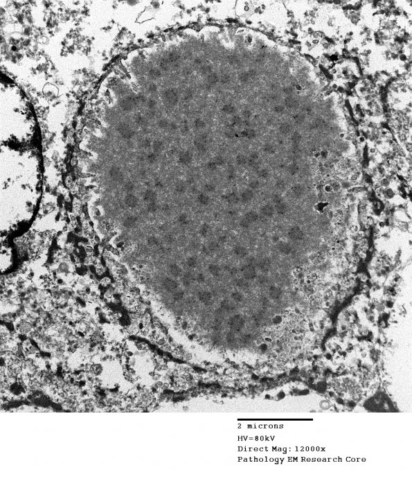 5H7 Meningioma, secretory (Case 5) EM 10 - Copy