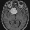 6A1 Meningioma, secretory (Case 6) MRI 1 - Copy