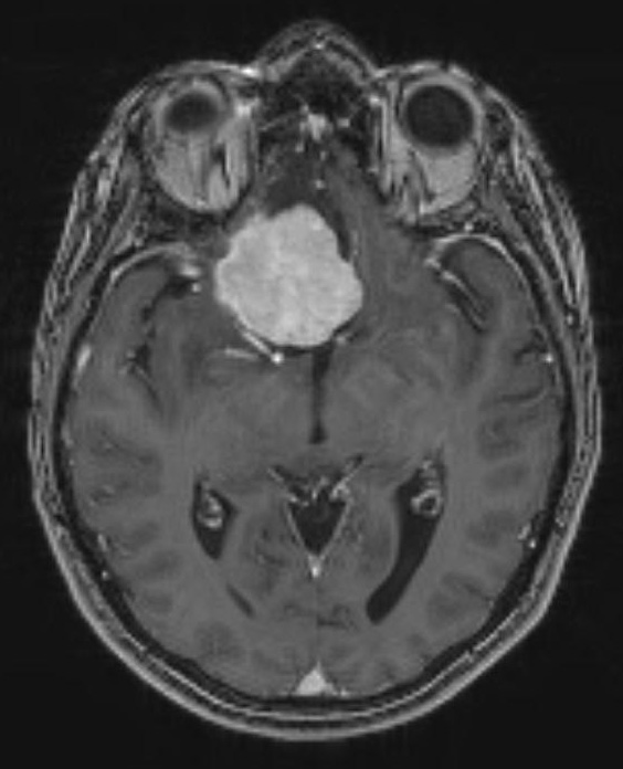 6A1 Meningioma, secretory (Case 6) MRI 1 - Copy