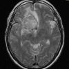 6A2 Meningioma, secretory (Case 6) T2 W 3 - Copy