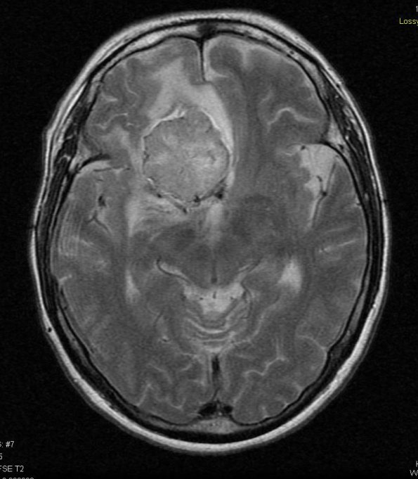 6A2 Meningioma, secretory (Case 6) T2 W 3 - Copy