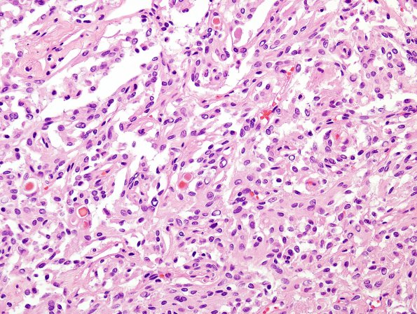 6B1 Meningioma, secretory (Case 6) H&E 3