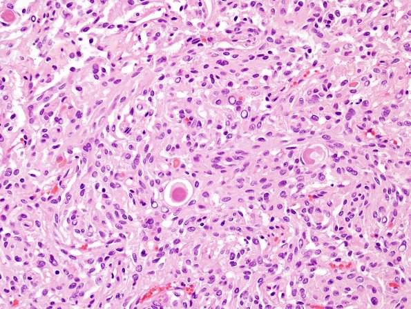 6B2 Meningioma, secretory (Case 6) H&E 4