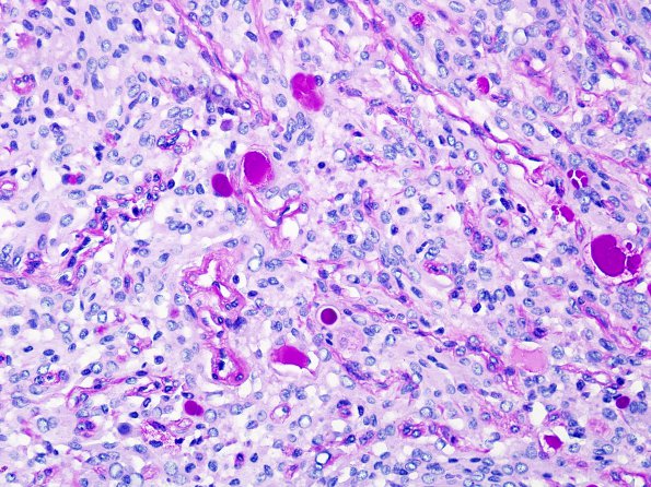 6C Meningioma, secretory (Case 6) PAS 1