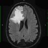 7A1 Meningioma, secretory (Case 7) Flair - Copy