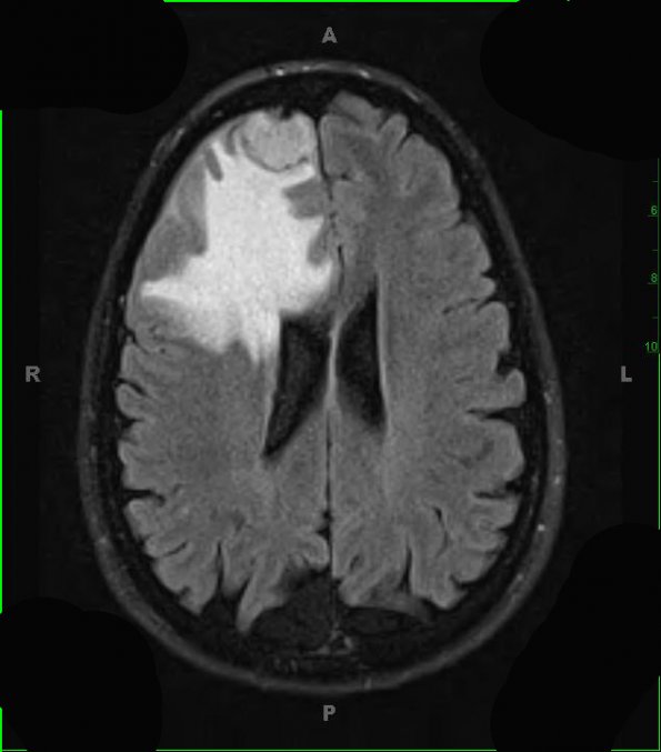 7A1 Meningioma, secretory (Case 7) Flair - Copy