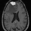 7A2 Meningioma, secretory (Case 7)-MRI-T1W - Copy