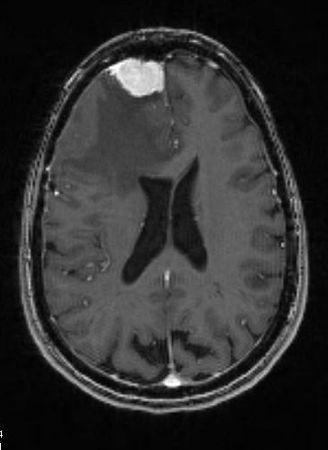 7A2 Meningioma, secretory (Case 7)-MRI-T1W - Copy