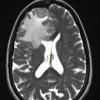 7A3 Meningioma, secretory (Case 7) MRI-T2 - Copy