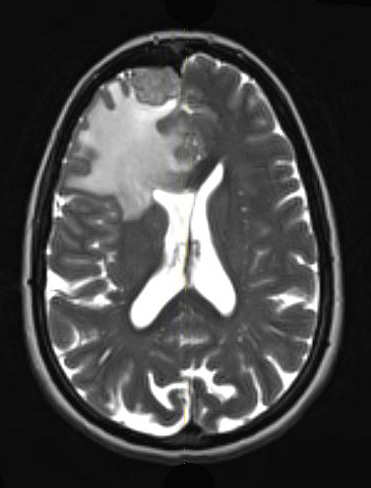 7A3 Meningioma, secretory (Case 7) MRI-T2 - Copy