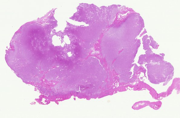 7B1 Meningioma, secretory (Case 7) H&E whole mount