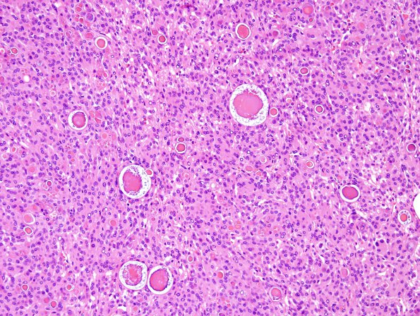 7B2 Meningioma, secretory (Case 7) H&E 2