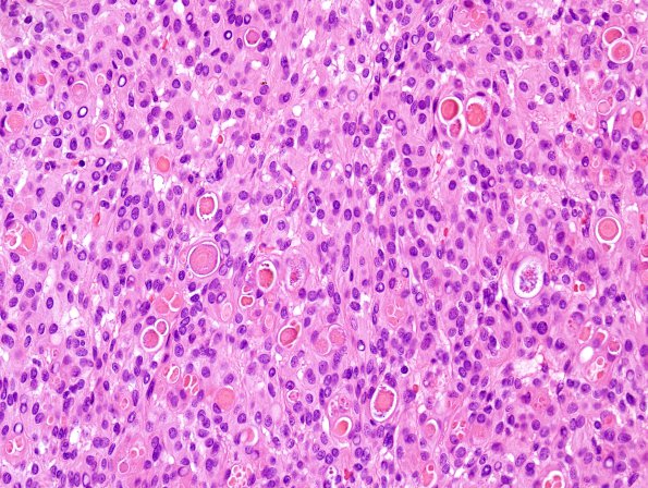 7B3 Meningioma, secretory (Case 7) H&E 6