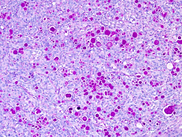 7D Meningioma, secretory (Case 7) PAS 3