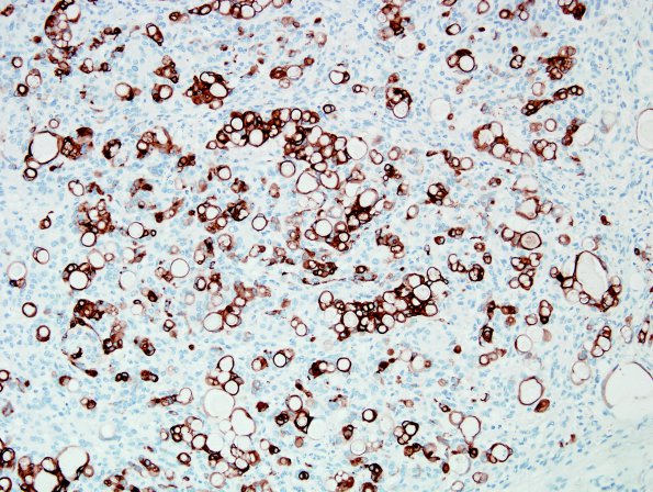 7E1 Meningioma, secretory (Case 7) CK 5