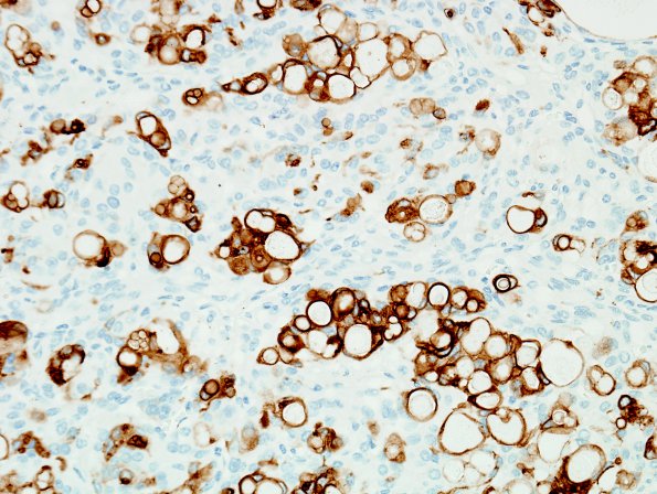 7E2 Meningioma, secretory (Case 7) CK 1