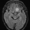 8A1 Meningioma, secretory (Case 8) FLAIR - Copy