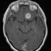 8A2Meningioma, secretory (Case 8) T1W - Copy