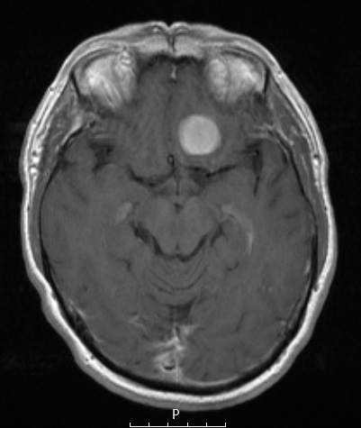 8A2Meningioma, secretory (Case 8) T1W - Copy