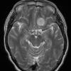 8A3 Meningioma, secretory (Case 8) T2 - Copy