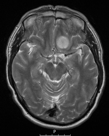 8A3 Meningioma, secretory (Case 8) T2 - Copy