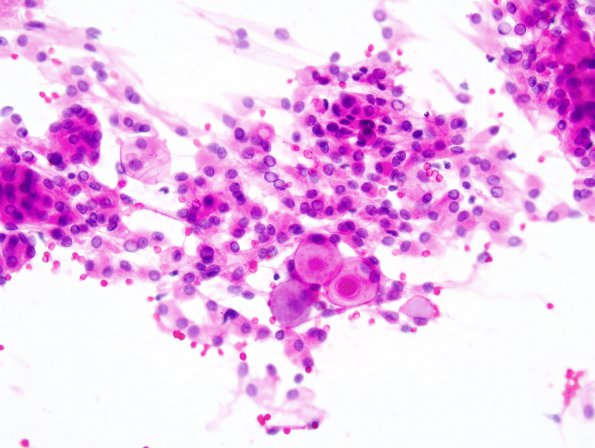 8B1 Meningioma, secretory (Case 8) Smear 1.jpg