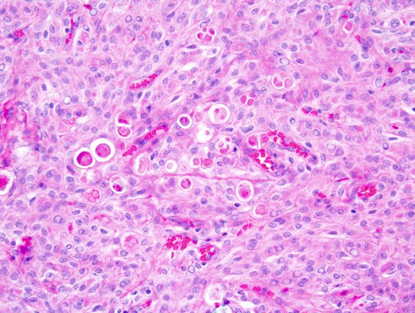 8B2 Meningioma, secretory (Case 8) 1.jpg