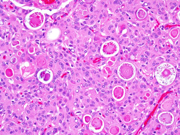 8B3 Meningioma, secretory (Case 8) 4.jpg