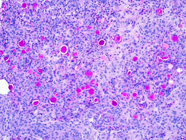 8C Meningioma, secretory (Case 8) PAS 1.jpg