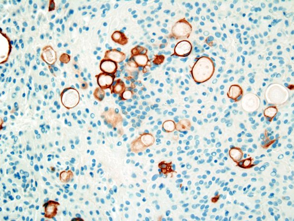 8D Meningioma, secretory (Case 8) CAM 5.jpg