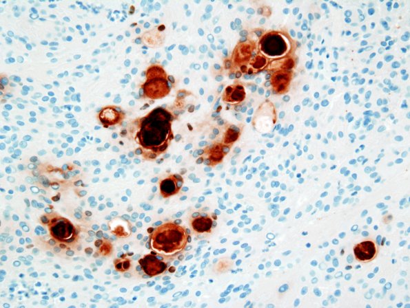 8E Meningioma, secretory (Case 8) CEA 3.jpg