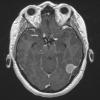 9A1 Meningioma, secretory hyperostosis (Case 9) T1 - Copy