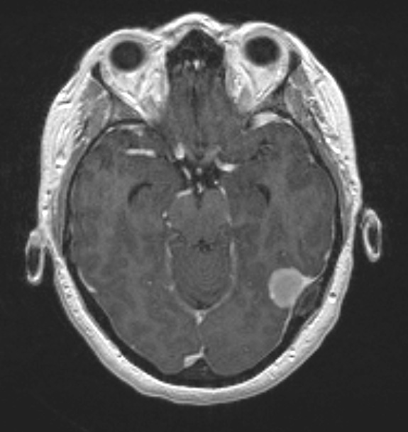 9A1 Meningioma, secretory hyperostosis (Case 9) T1 - Copy