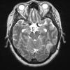 9A2 Meningioma, secretory hyperostosis (Case 9) T2 3 - Copy