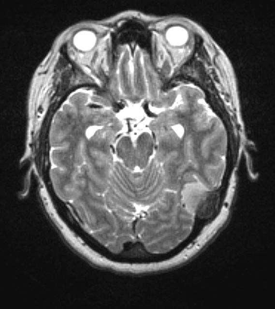 9A2 Meningioma, secretory hyperostosis (Case 9) T2 3 - Copy