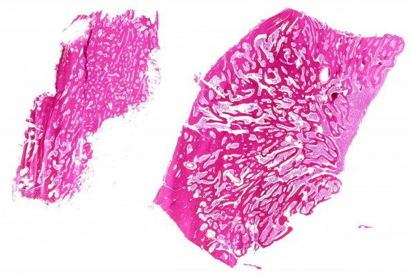 9B1 Meningioma, secretory, hyperostosis (Case 9) H&E WM