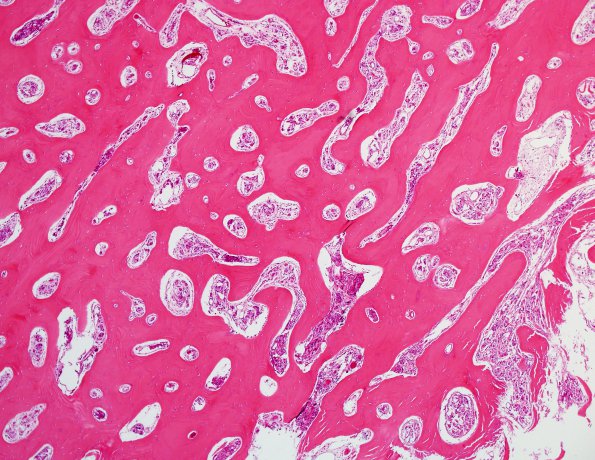 9B2 Meningioma, secretory, hyperostosis (Case 9) H&E 1.jpg