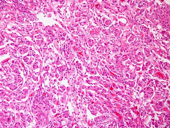 9B5 Meningioma, secretory, hyperostosis (Case 9) H&E 3.jpg