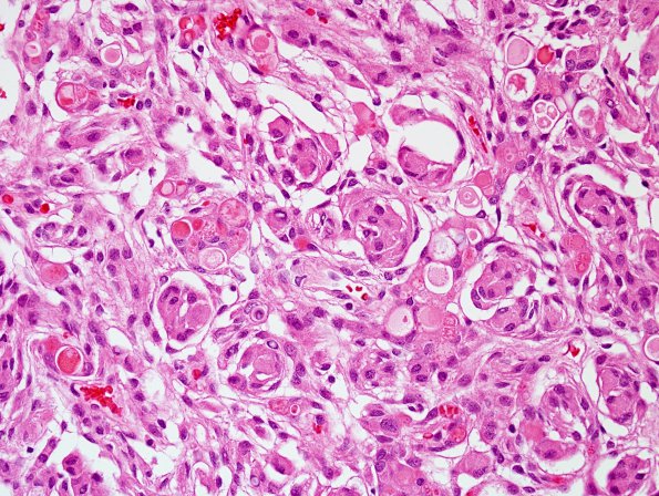 9B6 Meningioma, secretory, hyperostosis (Case 9) H&E 4.jpg