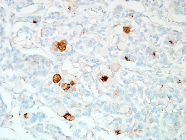 9C Meningioma, secretory, hyperostosis (Case 9) EMA 2.jpg