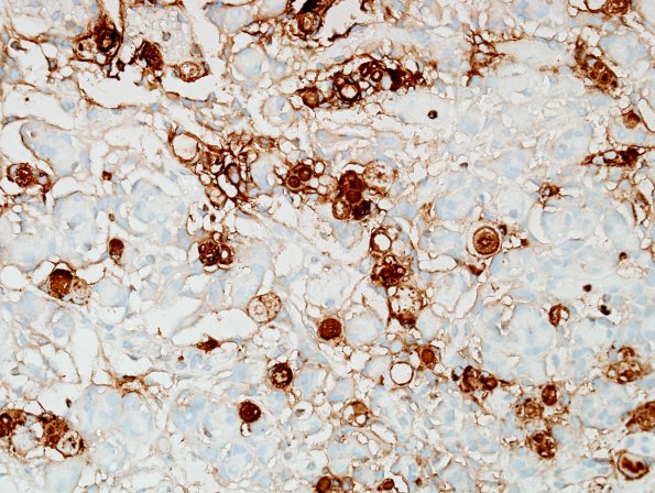 9E Meningioma, secretory, hyperostosis (Case 9) CEA-mono 2.jpg