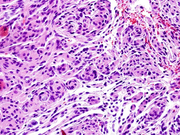 10A Meningioma (Case 10)  H&E 1