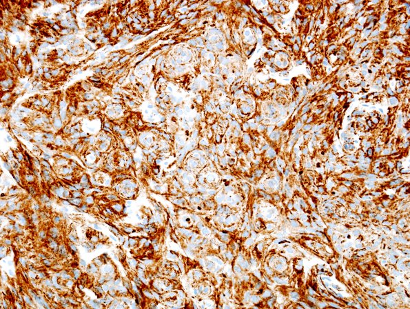 10B Meningioma (Case 10) EMA 1