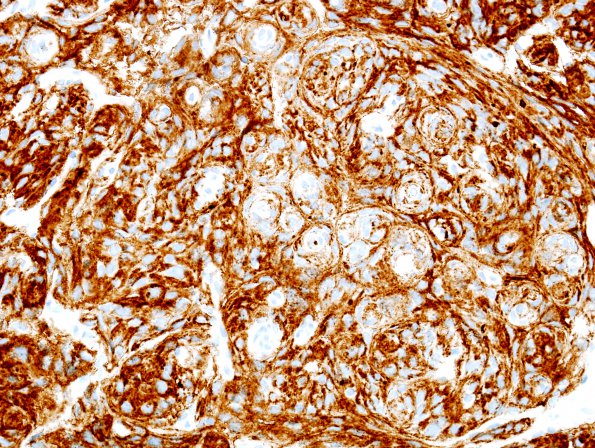 10B Meningioma (Case 10) EMA 2