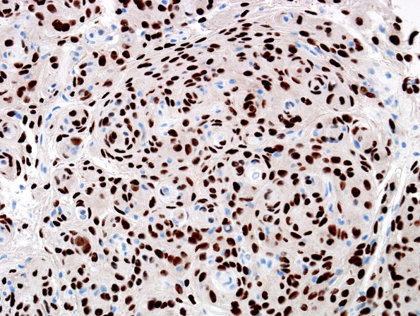 10C Meningioma (Case 10) PR