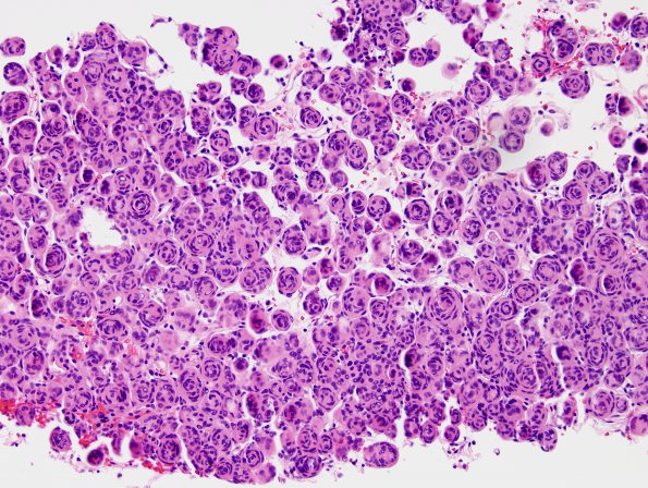 11A1 Meningioma, whorls (Case 11) H&E 1