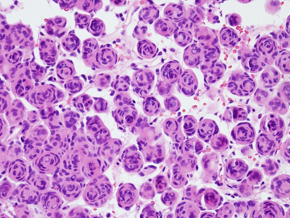 11A2 Meningioma, whorls (Case 11) H&E 2