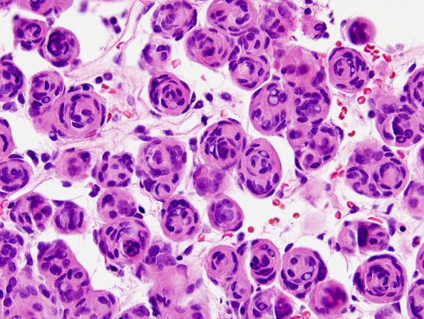 11A3 Meningioma, whorls (Case 11) H&E 3